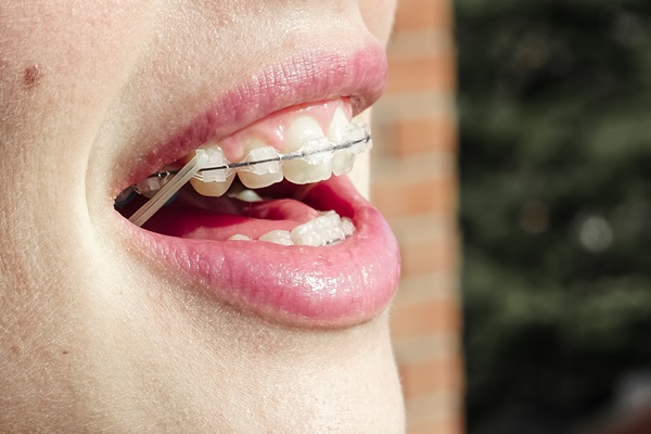 Who Is a Good Candidate for Ceramic Braces? - Braces By Abbadent Dubuque, IA