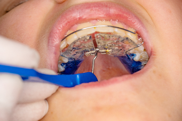 How a Palatal Expander Works - Braces By Abbadent Dubuque, IA